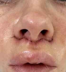 photo of a patient with contact dermatitis after a lip lift to depict potential lip lift complications